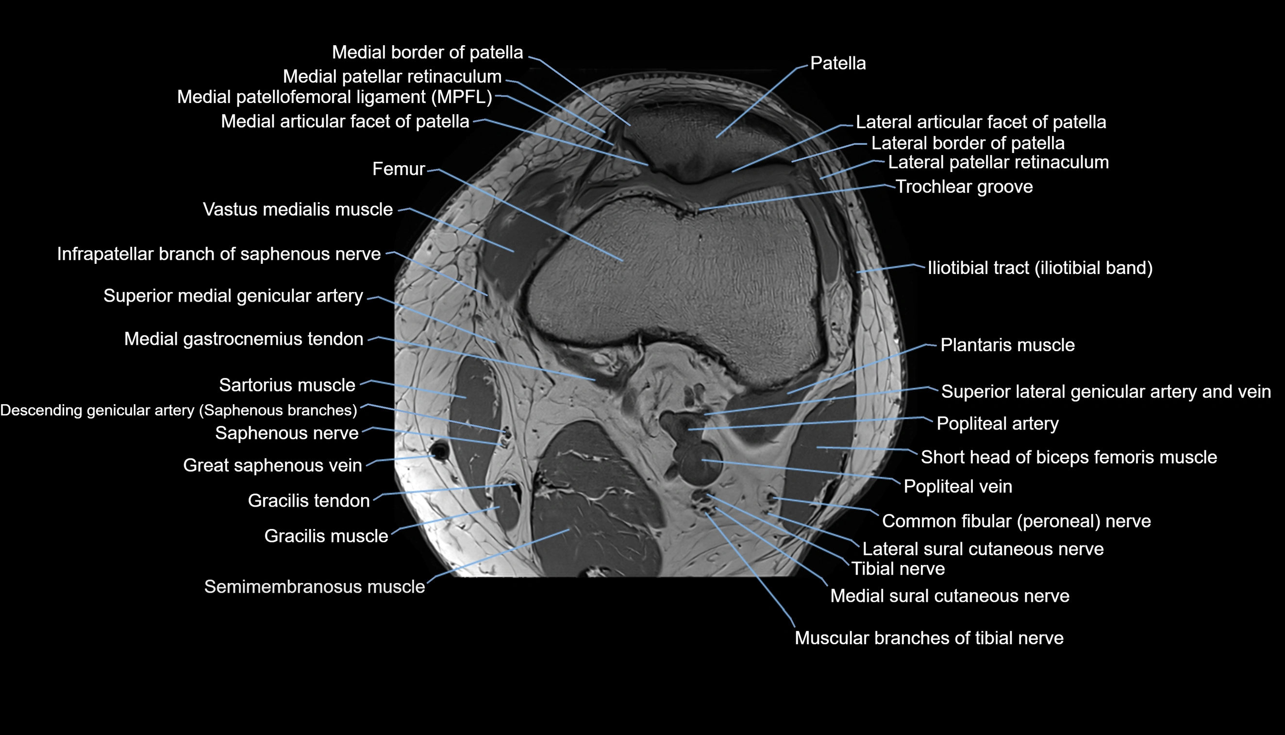 MRI knee  axial cross sectional anatomy 3T radiology  image-img-00001-00014.webp
